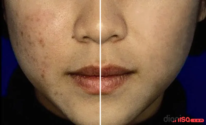 Hapus Jerawat Dengan Photoshop 2